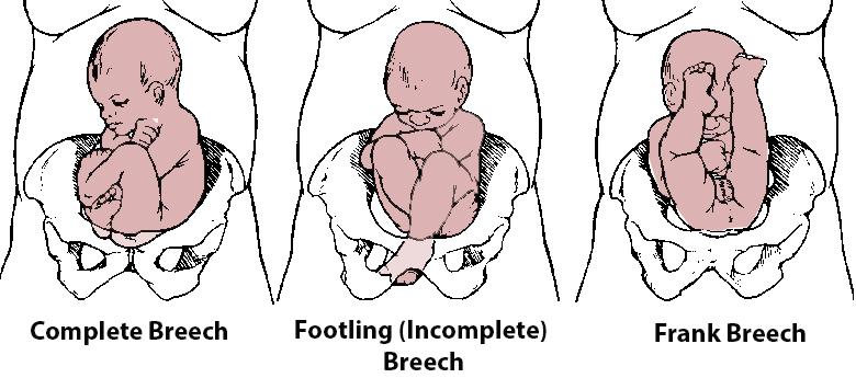 breech presentation with anterior placenta