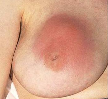 Breast contusion 