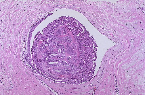 Papilloma with atypical ductal hyperplasia, Atypical ductal papilloma