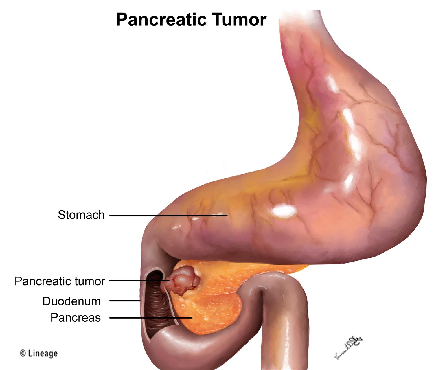 pancreatic cancer from pancreatitis