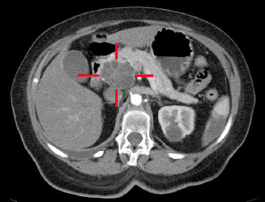 Pancreatic Cancer - Oncology - Medbullets Step 2/3