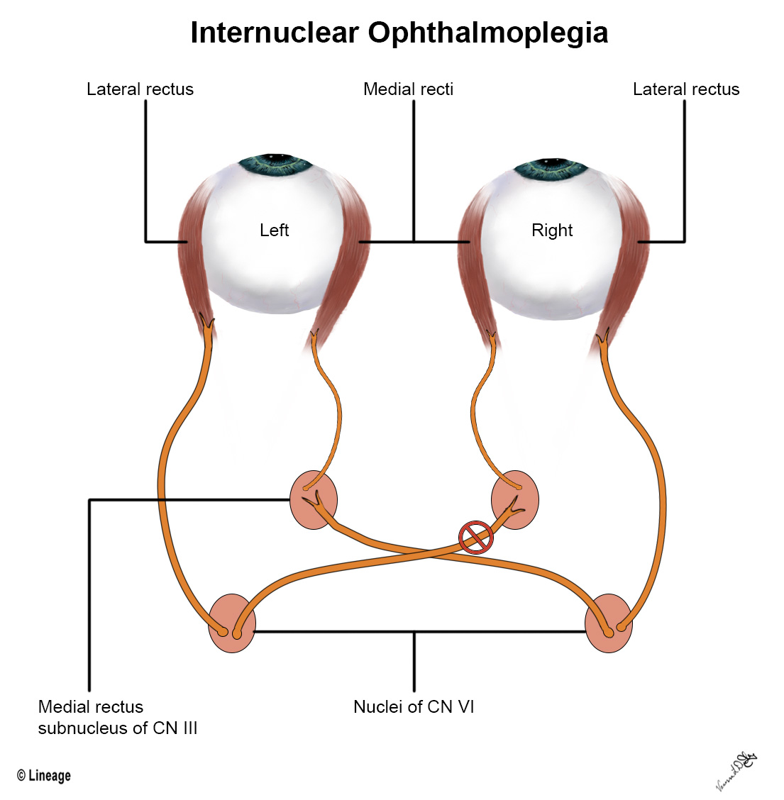 Internuclearophthalmoplegia 