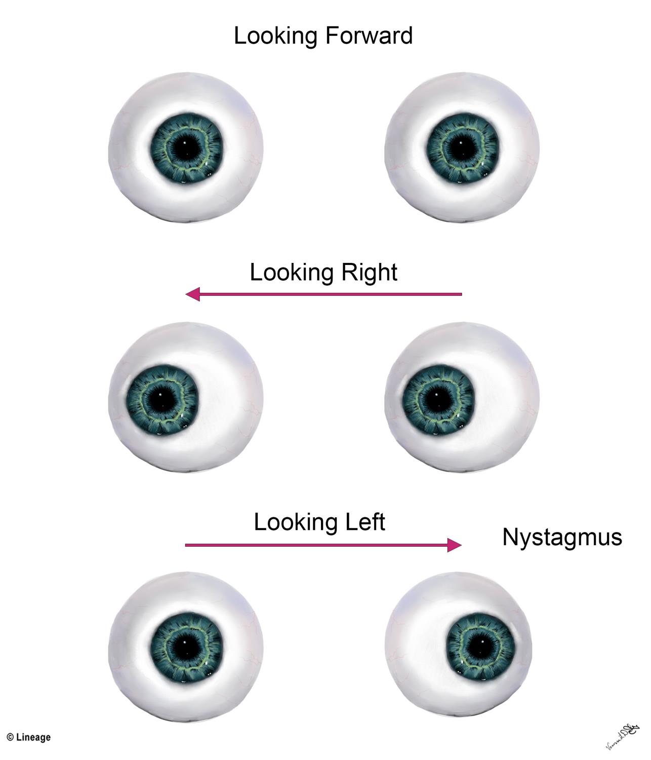 Internuclear Ophthalmoplegia