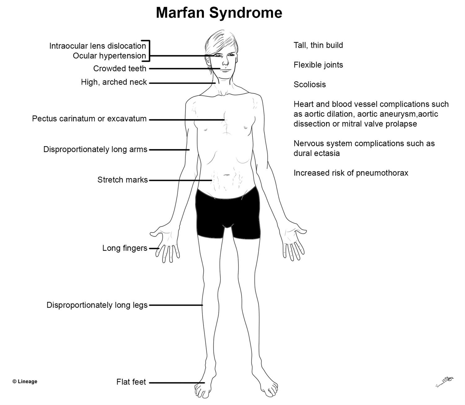 Marfan Syndrome - Orthopedics - Medbullets Step 2/3