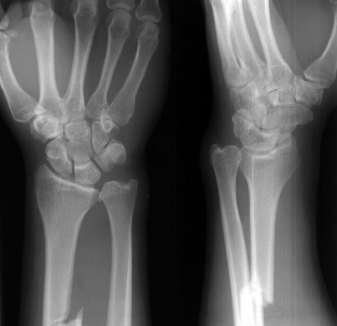 galeazzi fracture posna