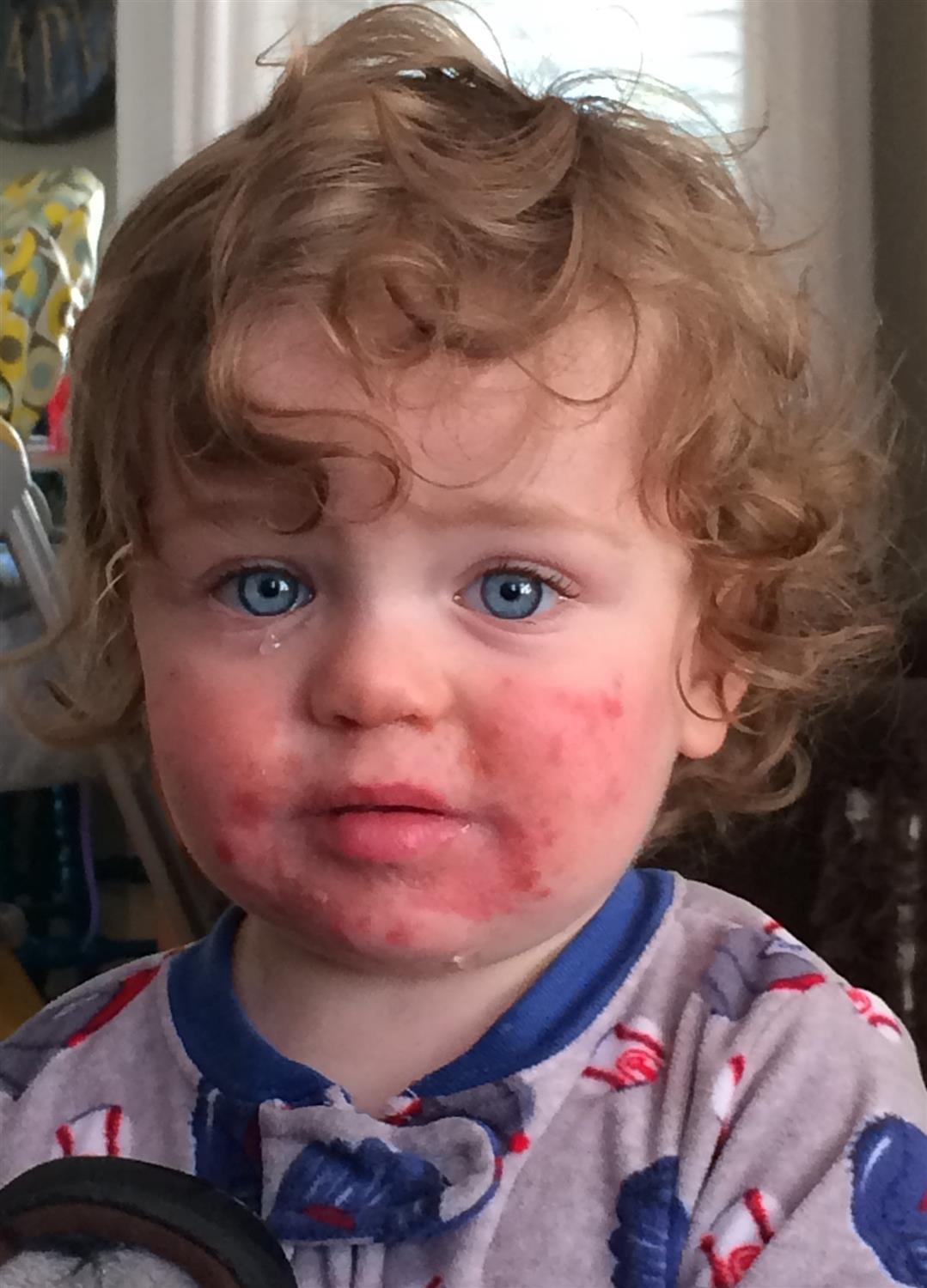 Erythema Infectiousum Fifth Disease Pediatrics Medbullets Step 2 3 Erythema Infectiousum Fifth Disease Pediatrics Medbullets Step 2 3