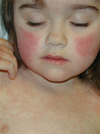 Reticular Rash Fifth Disease