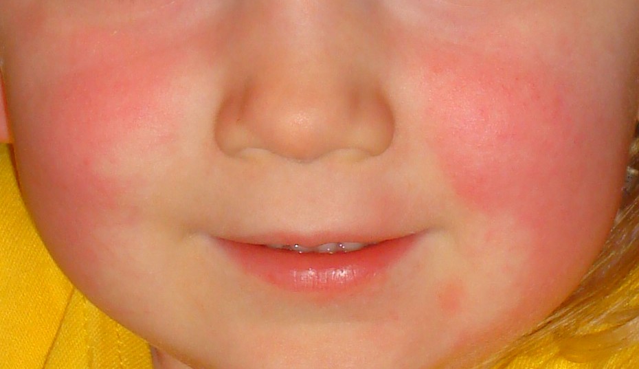 Everything you need to know about Scarlet Fever - NatureDoc