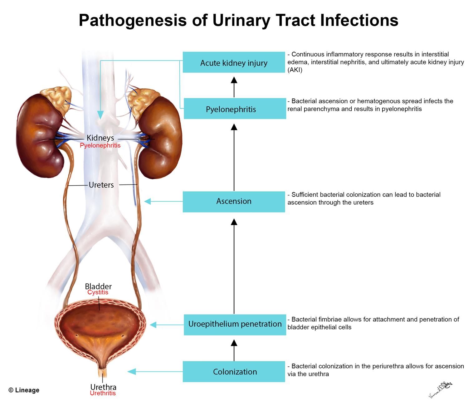 pathophysiology-of-an-uti-urinary-tract-infection-case-study