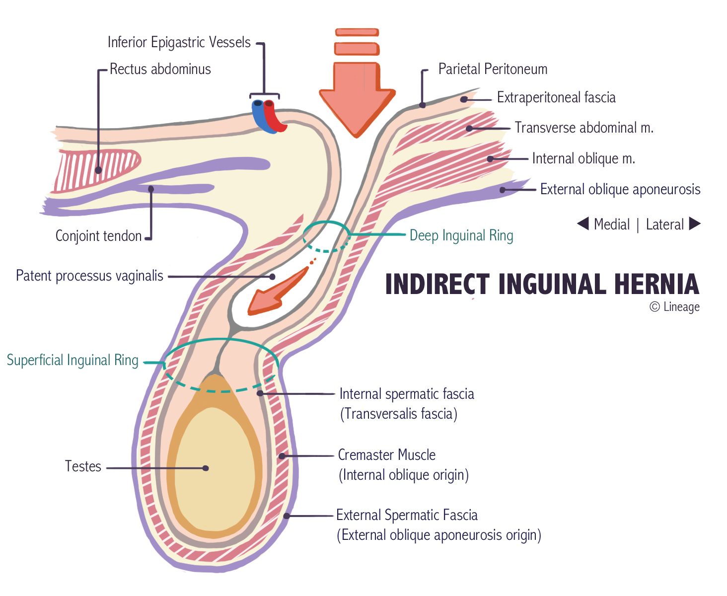 direct and indirect inguinal hernia