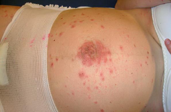 Herpes Gestationis / Pemphigoid Gestationis - Obstetrics ...