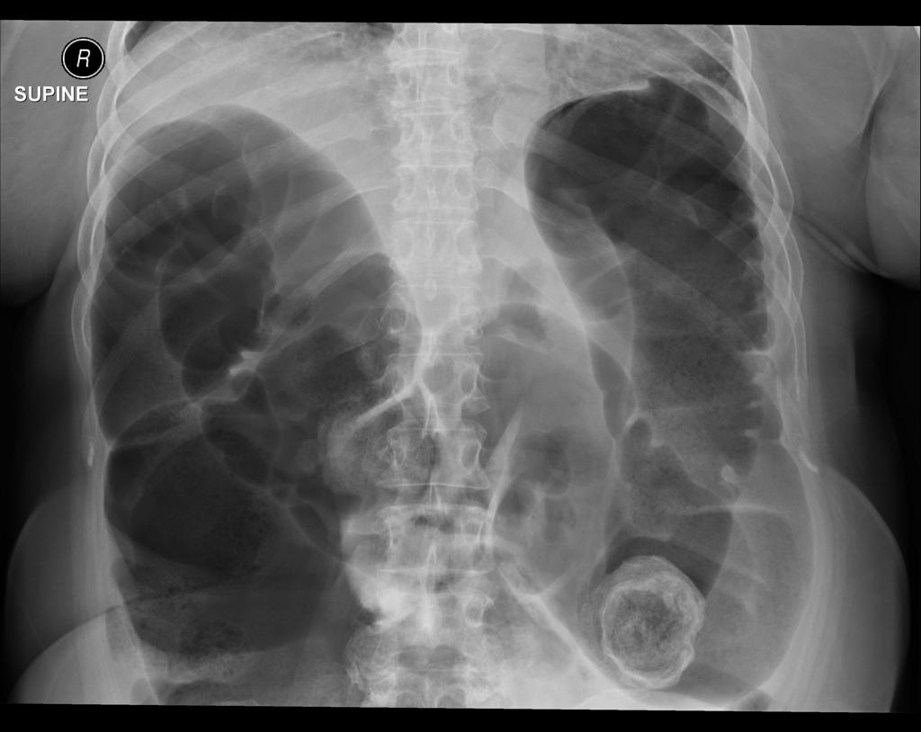 Large Bowel Obstruction Bowel Obstruction Signs Symptoms Causes Large Bowel Obstruction Bowel Obstruction Signs Symptoms Causes